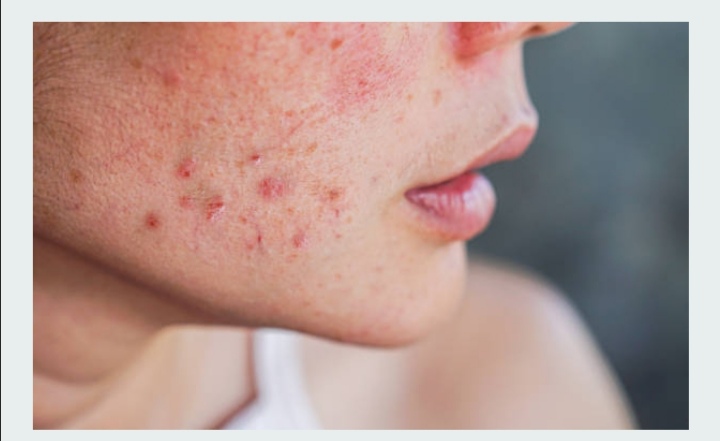 Acne, cause e rimedi