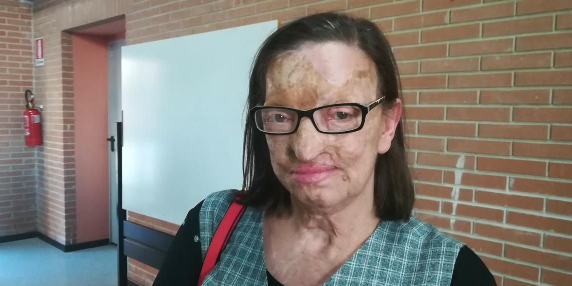 Castellammare, la testimonianza di Filomena Lamberti sfregiata dal marito 