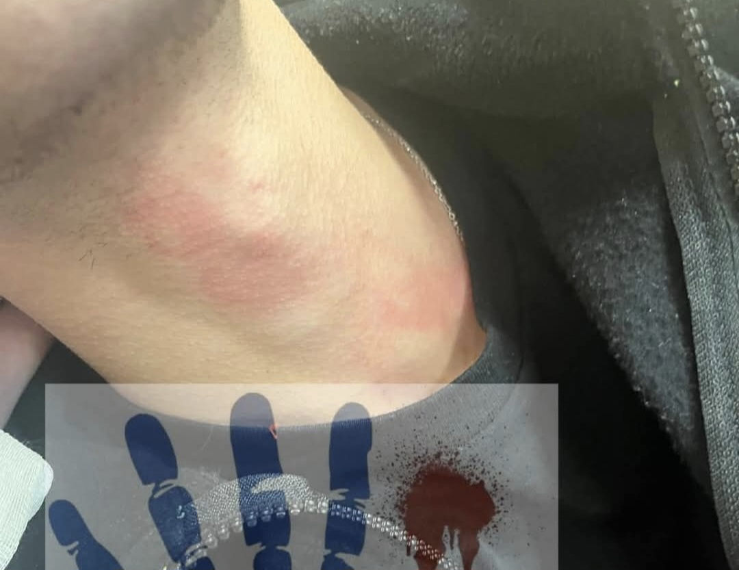 Torre del Greco, aggressione al Maresca: oss prende a pugni infermiere 