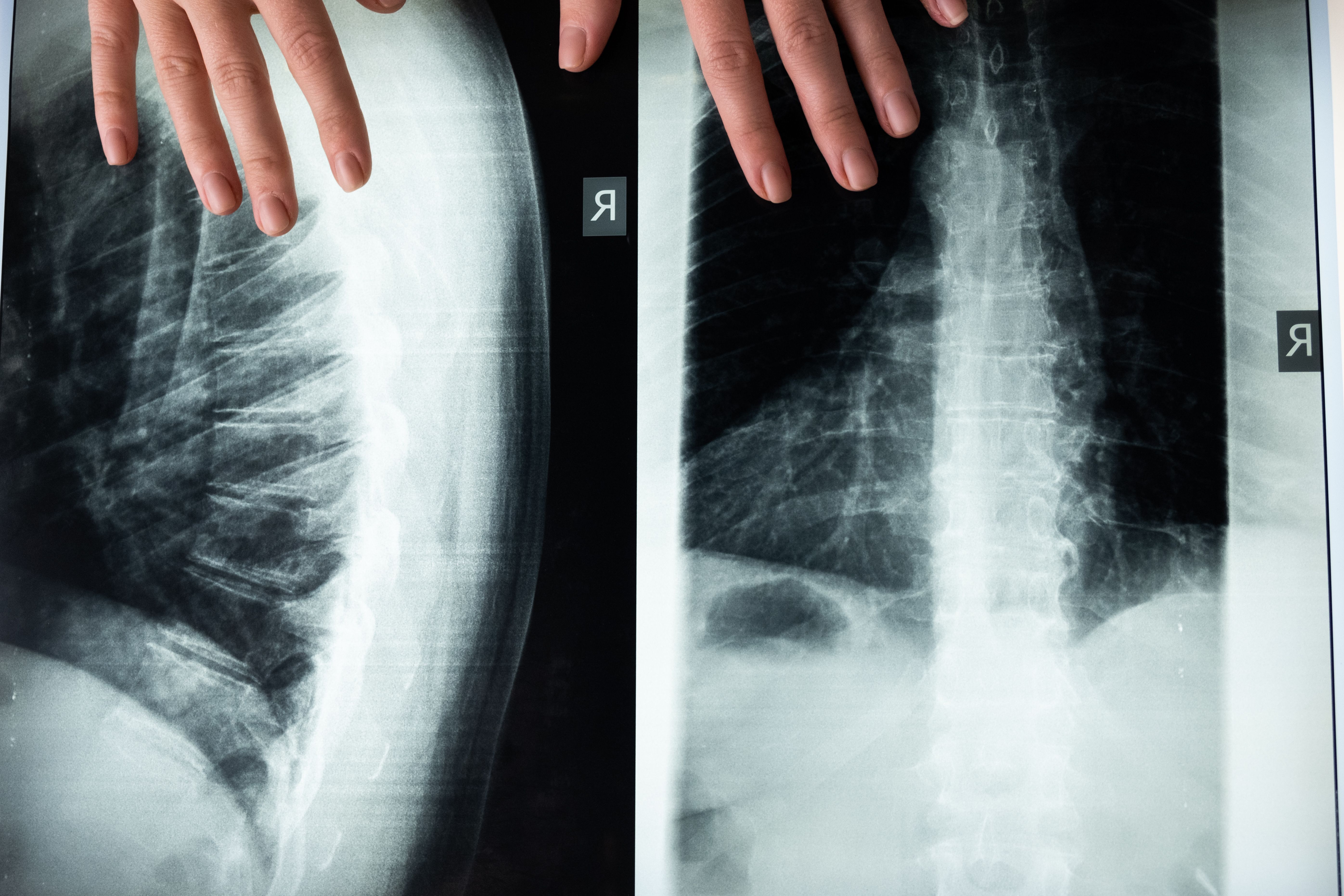 Assurdo a Giugliano: l'esito della radiografia è negativo, 72enne devasta il centro medico